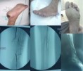 /album/galeria-de-fotos/pe%20diabetico%20com%20les%c3%b5es%20isqu%c3%aamicas-%20observar%20a%20oclus%c3%a3o%20da%20arteria%20femoral%20superficial%20e%20das%20arterias%20infra-patelares-%20a%20por%c3%a7%c3%a3o%20distal%20da%20ponte%20femoro-tibial%20anterior%20aparece%20no/